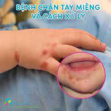 Bệnh chân tay miệng ở trẻ nhỏ